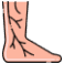 varicos veins.png
